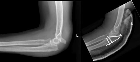 Olecranon Fracture Radiology At St Vincent S University Hospital | My ...