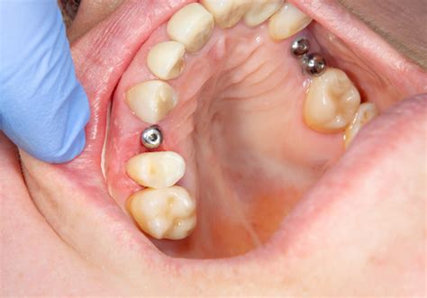 Dental Implants Infection | How to Avoid it? | Hackley DDS