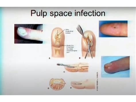 Hand Infections — OrthopaedicPrinciples.com