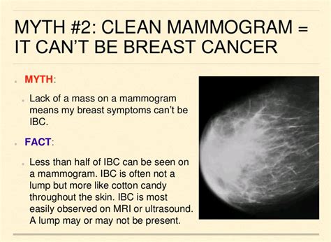 Inflammatory Breast Cancer Ultrasound