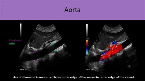 Aorta Anatomy Ultrasound