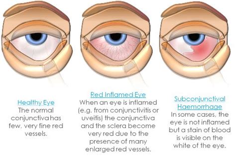 Red eye | Clinica London