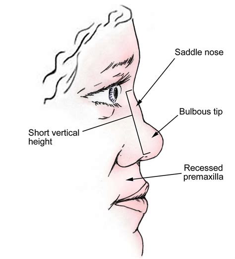 Saddle nose deformity causes, symptoms, diagnosis, treatment & prognosis