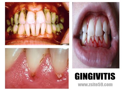 Z59 FAQS AND SHEETS OF INFORMATIONS AND STORIES: Gingivitis