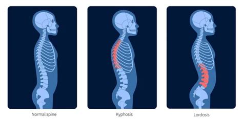 What Is Straightening of the Cervical Lordosis? - Regenexx