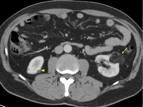 Kidney Mass Ct Scan