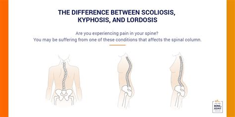 Kyphosis Lordosis Exercises