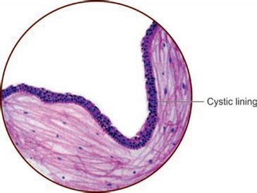 Globulomaxillary Cyst Histology