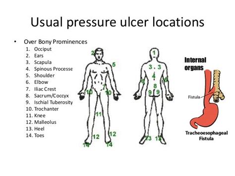 Right Ischial Pressure Ulcer