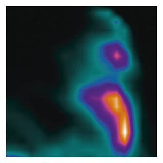 46-year-old patient with hormone receptor positive/Her2 negative... | Download Scientific Diagram