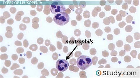 What is Leukopenia? - Causes & Types - Video & Lesson Transcript ...