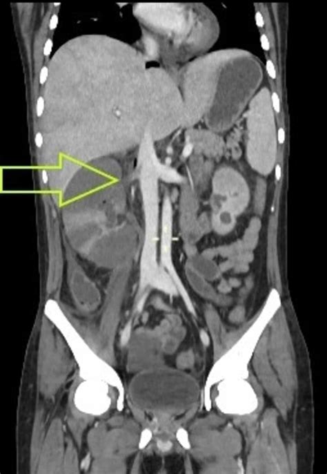 Cureus | A Rare Case of Paroxysmal Nocturnal Hemoglobinuria With ...