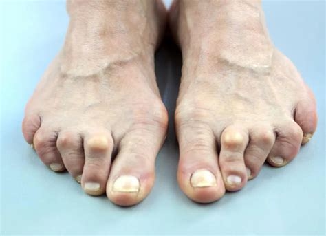 Claw toe : exercises and prevention of deformity | Podexpert