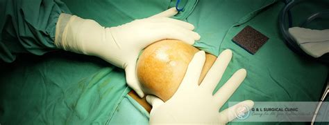 Skin Lipoma Surgery - Dr Ganesh Ramalingam, M.D.