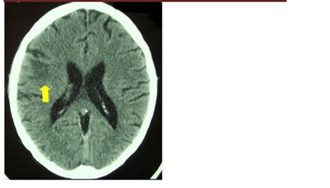 Toxoplasmosis cerebral. TAC simple de hombre de 28 años de edad que... | Download Scientific Diagram