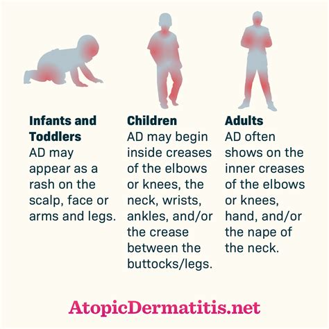 How Eczema Impacts People of Different Ages