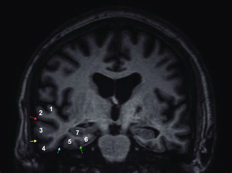 Coronal T1-weighted MRI sequence showing the normal anatomy of the... | Download Scientific Diagram