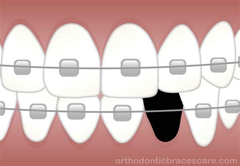 Can Braces Really Close Missing Tooth Gap - Orthodontic Braces Care