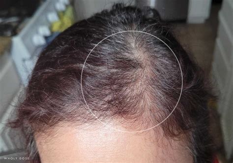 How To Take Biotin For Hair Growth, w/ Before & After Picture Results ...