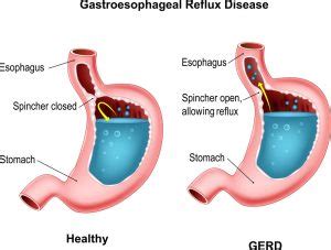 The Difference Between Gastritis and Gastroesophageal Reflux Disease (GERD) - Geriatric Academy