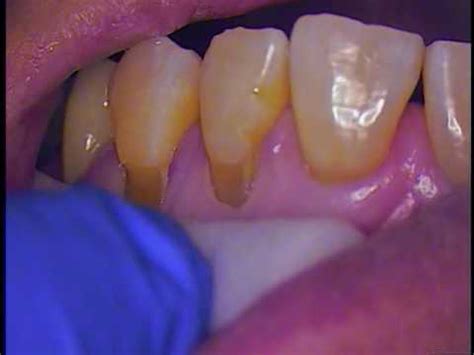 Tooth Color Filling - Class V non-carious lesion caused by gingival toothpaste abrasion - YouTube