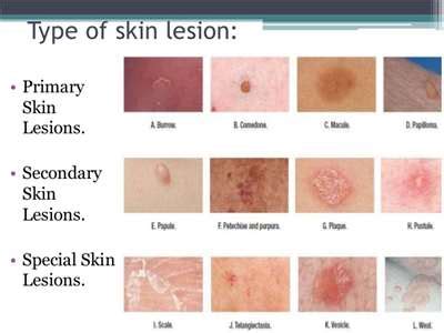 Identify Skin Lesions