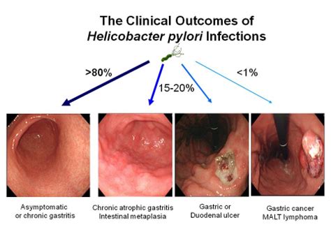 Cancers | Free Full-Text | Detouring the Undesired Route of Helicobacter pylori-Induced Gastric ...