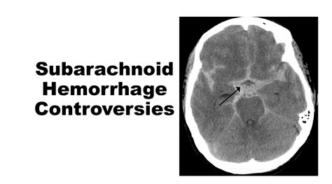 emDOCs.net – Emergency Medicine EducationControversies in the Diagnosis of Subarachnoid ...