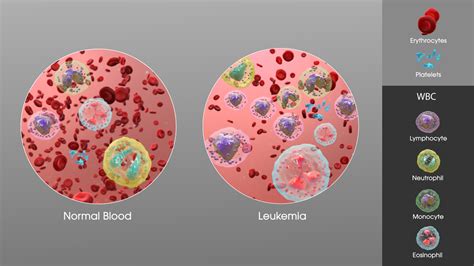 Complications of leukemia | General center | SteadyHealth.com