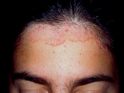 Malassezia Dermatitis On Scalp