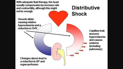 Distributive shock | Emt study, Emergency nursing, Critical care nursing