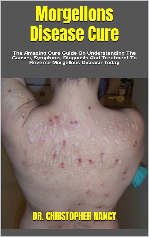 Morgellons Disease Cure : The Amazing Cure Guide On Understanding The ...