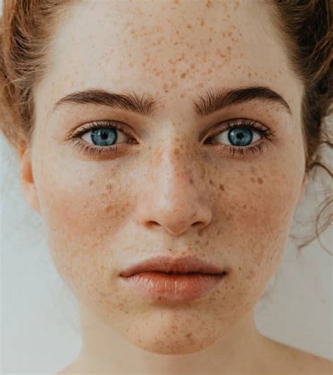 Reduce the appearance of Sun Damage & Freckles