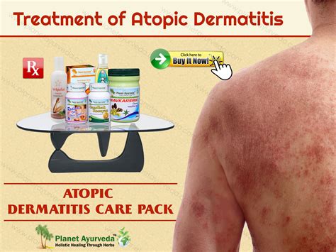 Treatment of Atopic Dermatitis with Natural Herbal Remedies