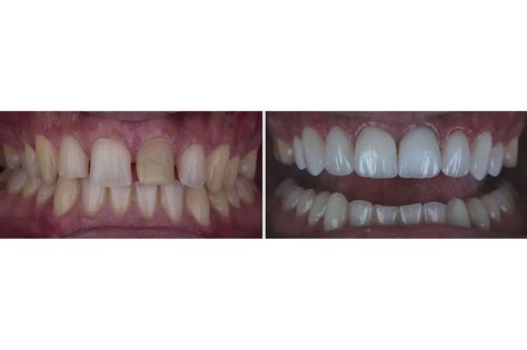 Full Mouth Reconstruction Linwood NJ | Dentistry