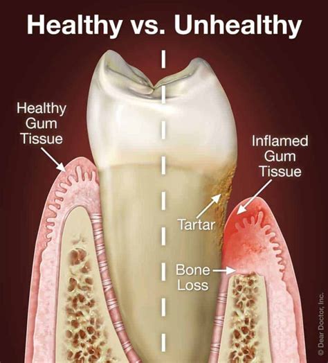 Bleeding Gums: Causes And Treatment In Gurgaon | Dantkriti Dental Clinic