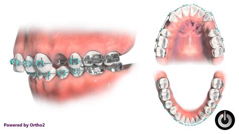 Upper 1st Premolar Extraction - YouTube