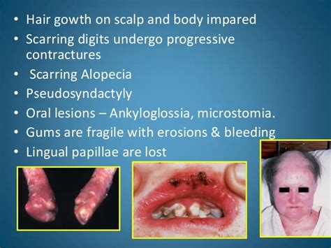 Epidermolysis Bullosa Simplex