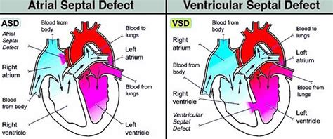 Hole in heart causes, symptoms, prognosis, diagnosis and treatment