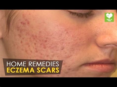 Eczema Scars - Home Remedies | Health Tone Tips - YouTube