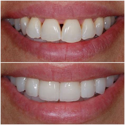 No-Prep Veneers Glendale | Burbank | Pacific Dental Care