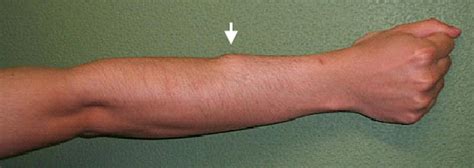 Pitcures Of The Tendons In Tbe Forearm / Elbow/Forearm Tendon Ligament Tear | Health Life Media ...