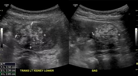 Kidney Tumors in Children and Teens - Together