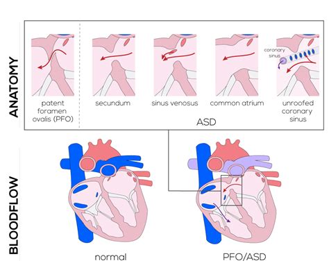 Congenital Defects Tutorial - Congenital Heart Defects | Atlas of Human ...