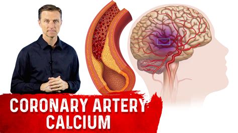 How to Read a (CAC) Score | Healthy Keto™ Dr. Berg