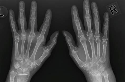 Erosive Arthritic Condition – RA – Undergraduate Diagnostic Imaging Fundamentals