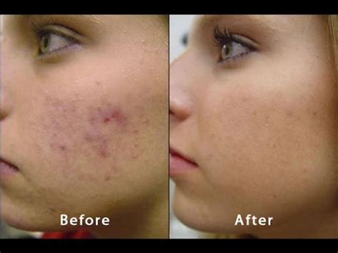 About Microdermabrasion | Before & After Acne Scars Blackheads PMD ...