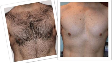 Natural chest hair removal options at home for men