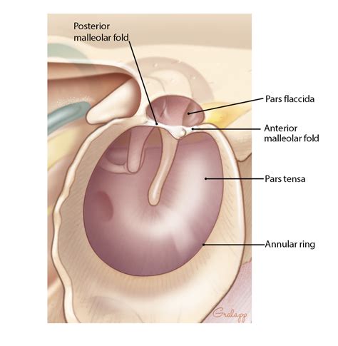 Tympanic Membrane Perforations – Oto Surgery Atlas