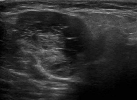 Head and Neck | 4.3 Salivary glands : Case 4.3.4 Warthin's tumors | Ultrasound Cases